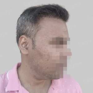 wrong hair transplant