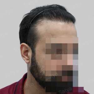 corrective hair transplant