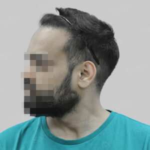 repair hair transplant