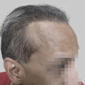 repair hair transplant