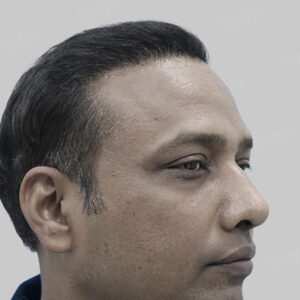repair hair transplant