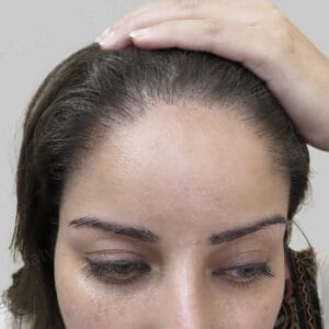 female hair transplant