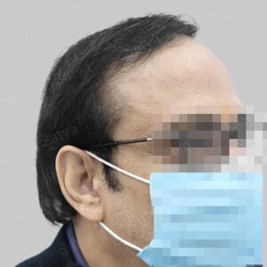 hair transplant