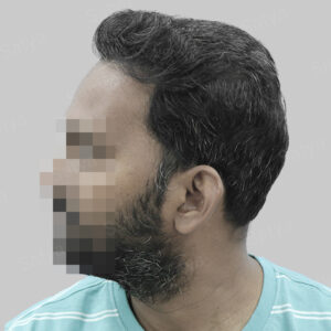 synthetic hair implant