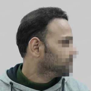 repair hair transplant