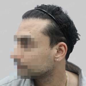 repair hair transplant