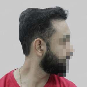 repair hair transplant result in India