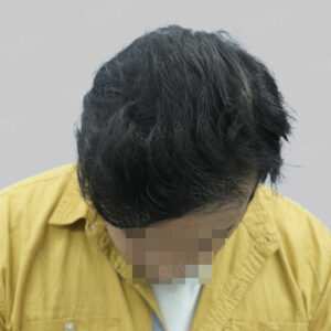 repair hair transplant