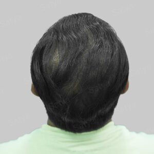 wrong hair transplant