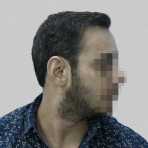 corrective hair transplant