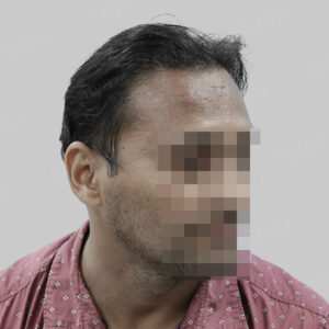 repair hair transplant