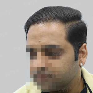 corrective hair transplant