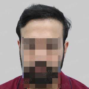 corrective hair transplant