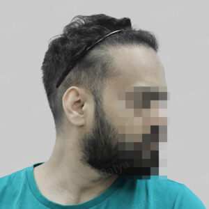 repair hair transplant
