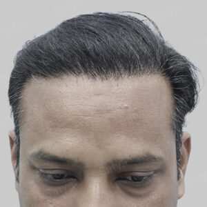 repair hair transplant