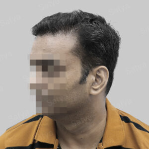 wrong hair transplant