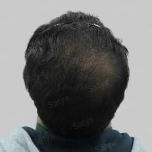 repair hair transplant