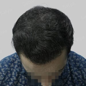 corrective hair transplant
