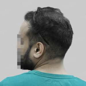 repair hair transplant