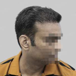 wrong hair transplant