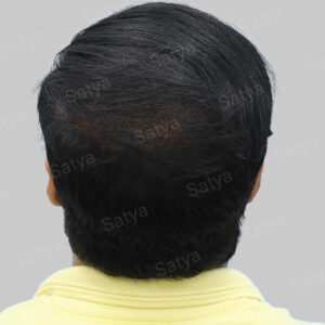 repair hair transplant