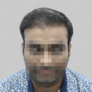 corrective hair transplant