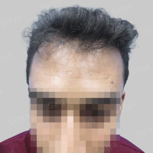 repair hair transplant