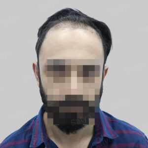 repair hair transplant result in India