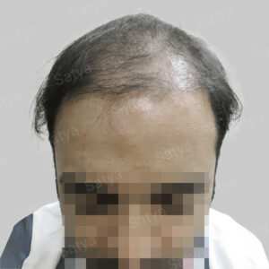 corrective hair transplant