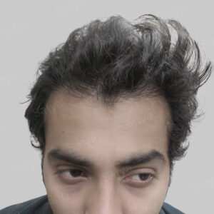 wrong hair transplant