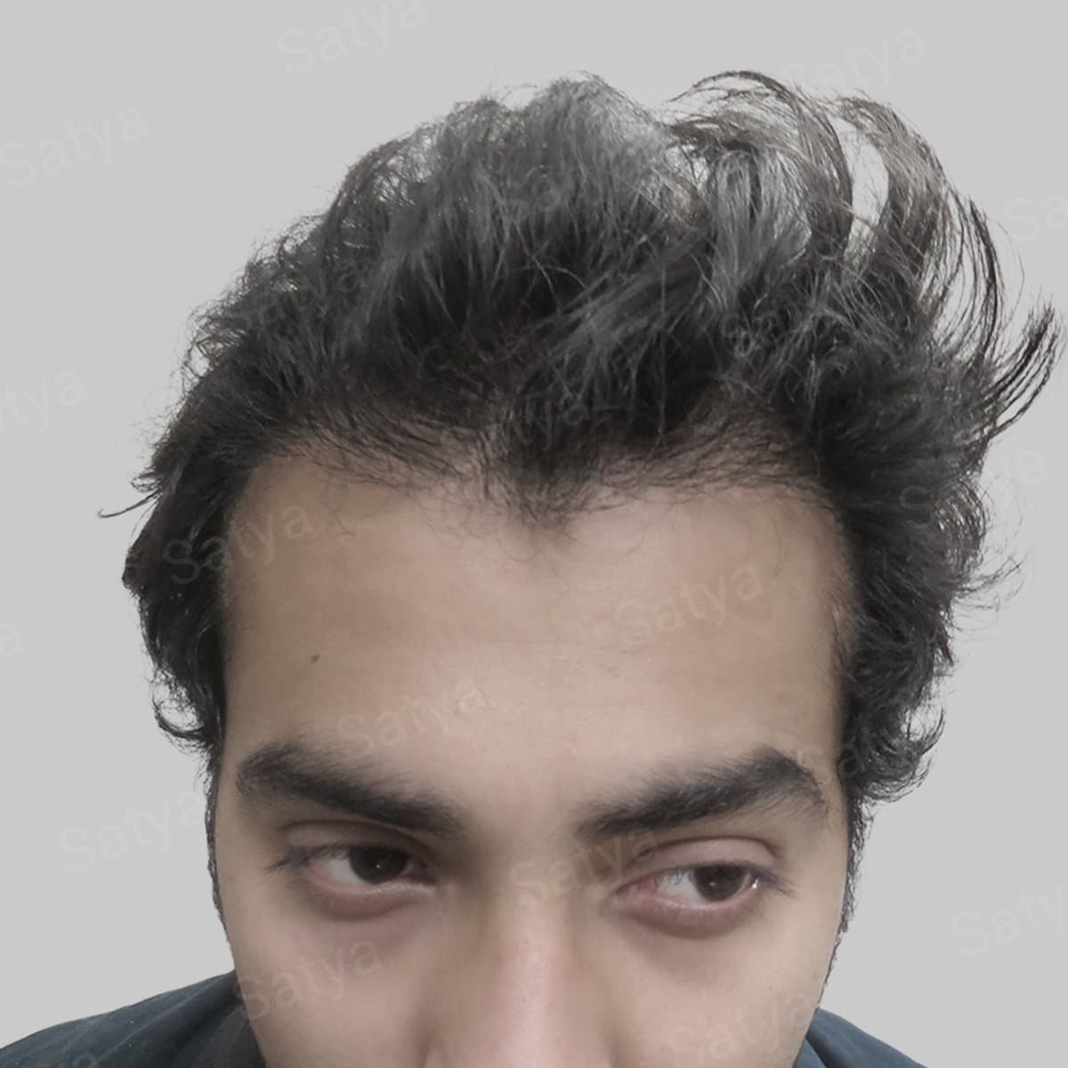 wrong hair transplant