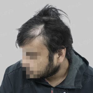 repair hair transplant