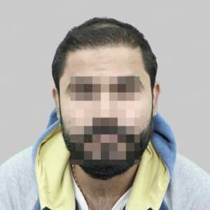 wrong hair transplant