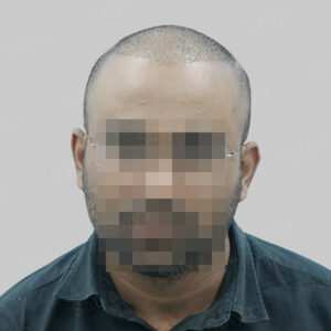 wrong hair transplant