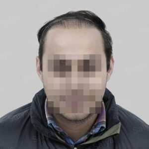 corrective hair transplant