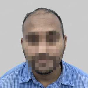 repair hair transplant