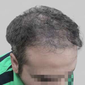 wrong hair transplant