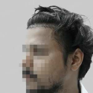 repair hair transplant