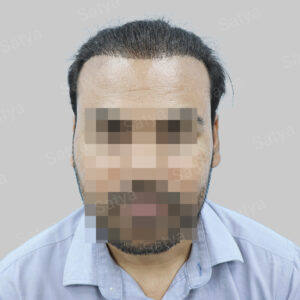 wrong hair transplant