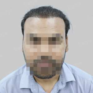 wrong hair transplant