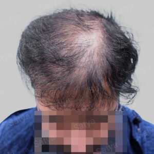 corrective hair transplant