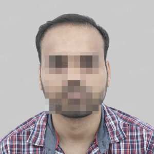repair hair transplant