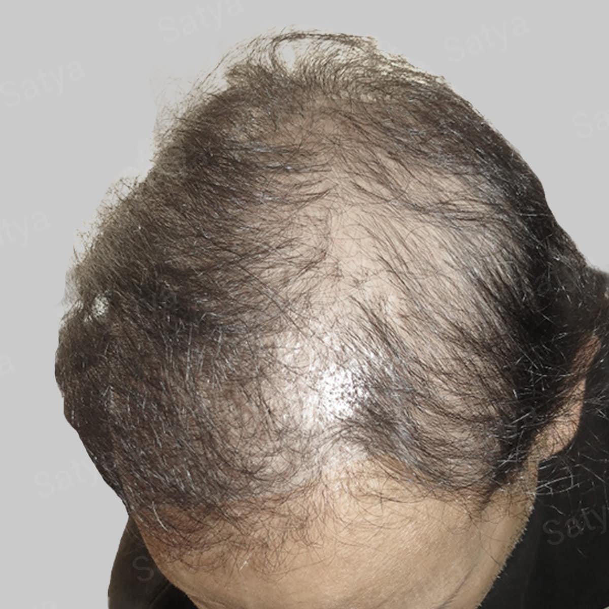 repair hair transplant