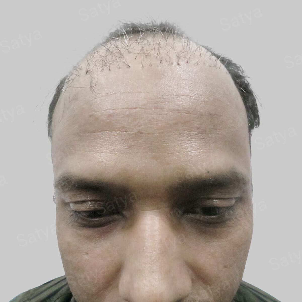 repair hair transplant