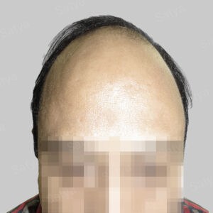 hair transplant