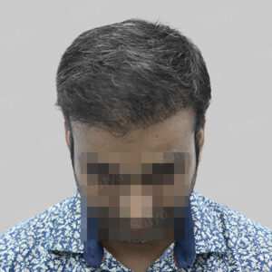 wrong hair transplant