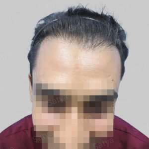 repair hair transplant