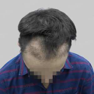 repair hair transplant result in India