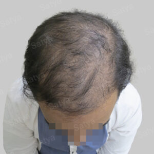 repair hair transplant