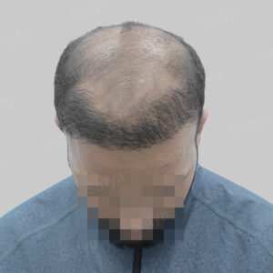 repair hair transplant